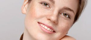 how to get rid of freckles